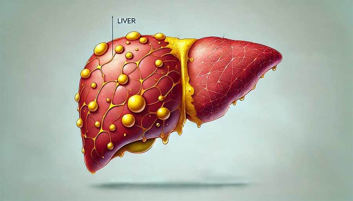 بهترین راهکار برای درمان کبد چرب