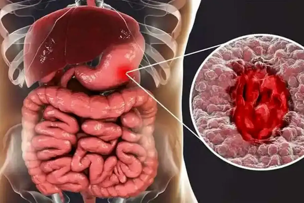 اصلی ترین عامل بروز زخم معده شناسایی شد