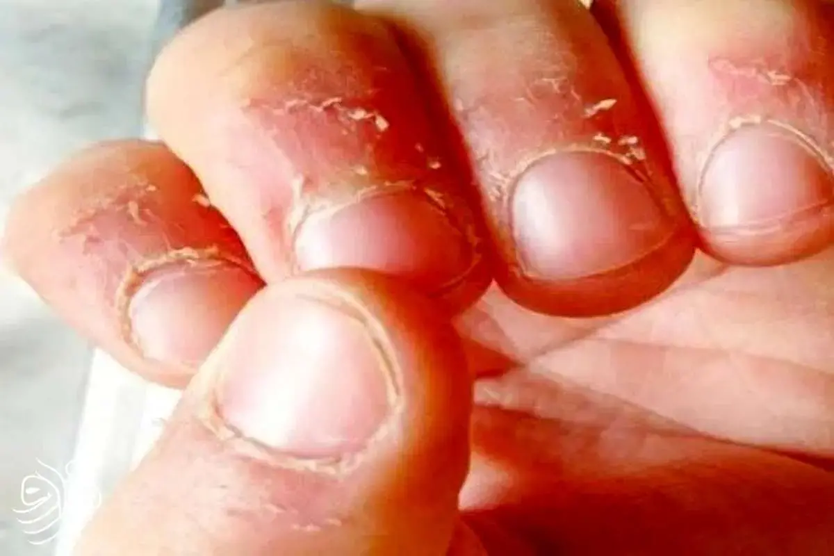 چرا ناخن می‌جویم؟/ راهکار ترک این عادت چیست؟
