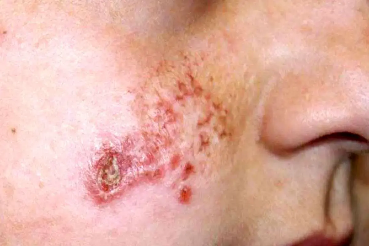 هشدار جدی درباره شیوع انگل خطرناک