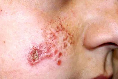 هشدار جدی درباره شیوع انگل خطرناک