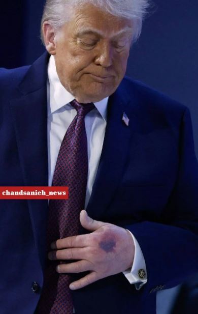 یک تصویر عجیب از دونالد ترامپ خبرساز شد/ بیماری ترامپ چیست؟ + عکس