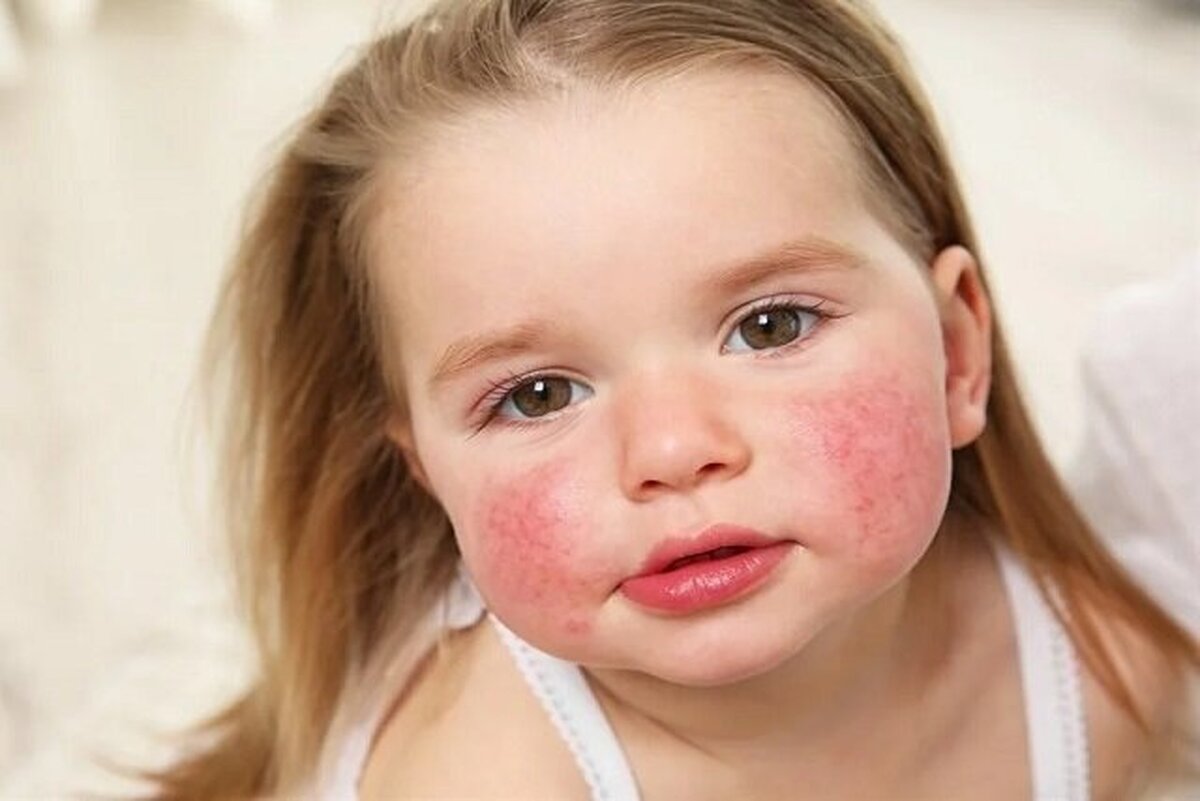 علت ایجاد آلرژی یا حساسیت غذایی در کودکان چیست؟