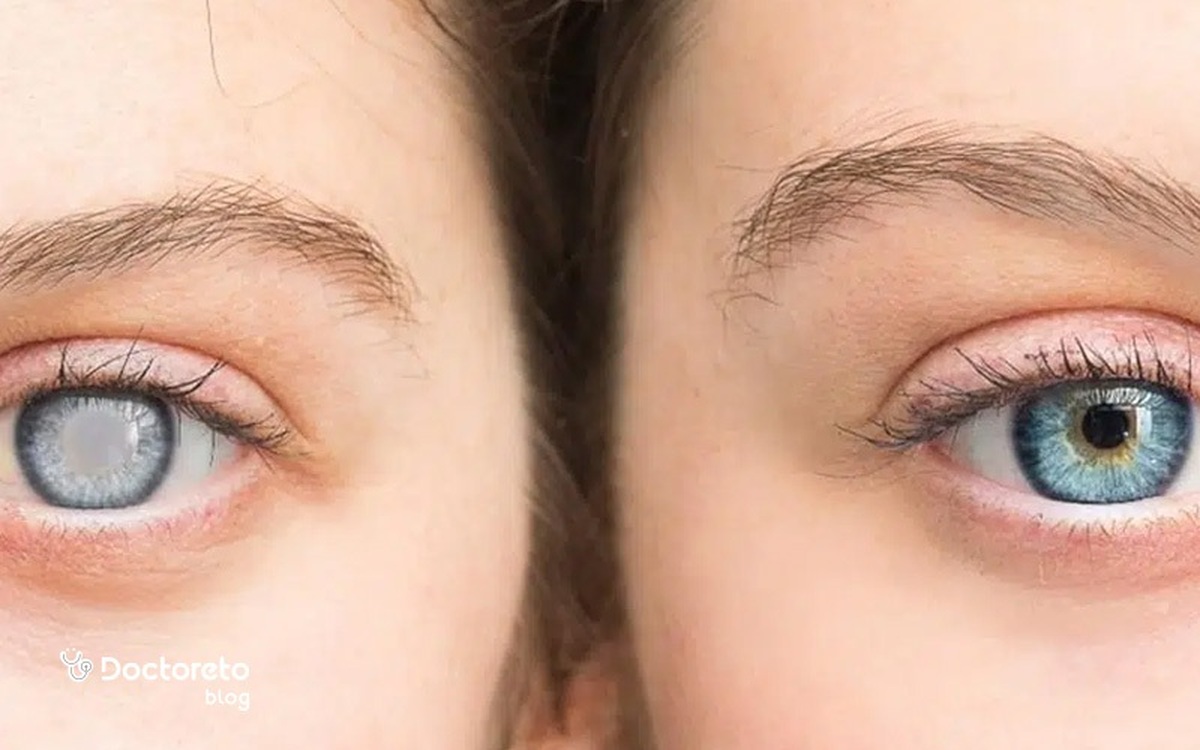 اینفوگرافیک/ چه عواملی باعث آب مروارید می‌شود؟