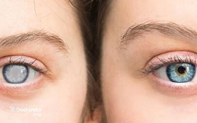 اینفوگرافیک/ چه عواملی باعث آب مروارید می‌شود؟