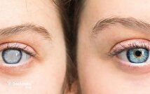 اینفوگرافیک/ چه عواملی باعث آب مروارید می‌شود؟