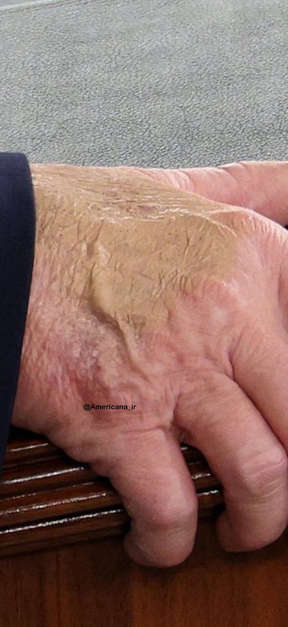 دست ترامپ سوژه شد / آیا وضعیت جسمانی رئیسجمهور آمریکا نگرانکننده است؟ دست ترامپ سوژه شد / آیا وضعیت جسمانی رئیسجمهور آمریکا نگرانکننده است؟