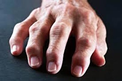 ورم انگشت‌ها چه زمانی خطرناک می‌شود؟+ علت و دلایل