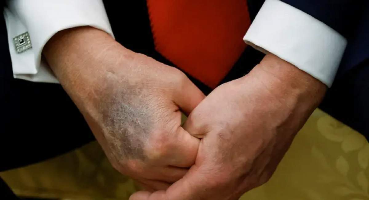 واکنش ونس به کبودی دست ترامپ/ اتفاقات وحشتناکی رخ داده است! واکنش ونس به کبودی دست ترامپ/ اتفاقات وحشتناکی رخ داده است!