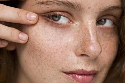 علت ایجاد لکهای پوستی و راههای درمان آن