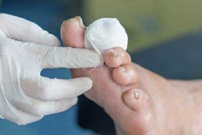 خبرخوش برای بیماران دیابتی/ افتتاح مرکز ملی زخم در تهران