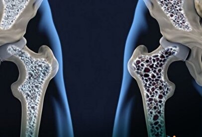 با مصرف این ویتامین‌ها استخوان‌های خود را تقویت کنید