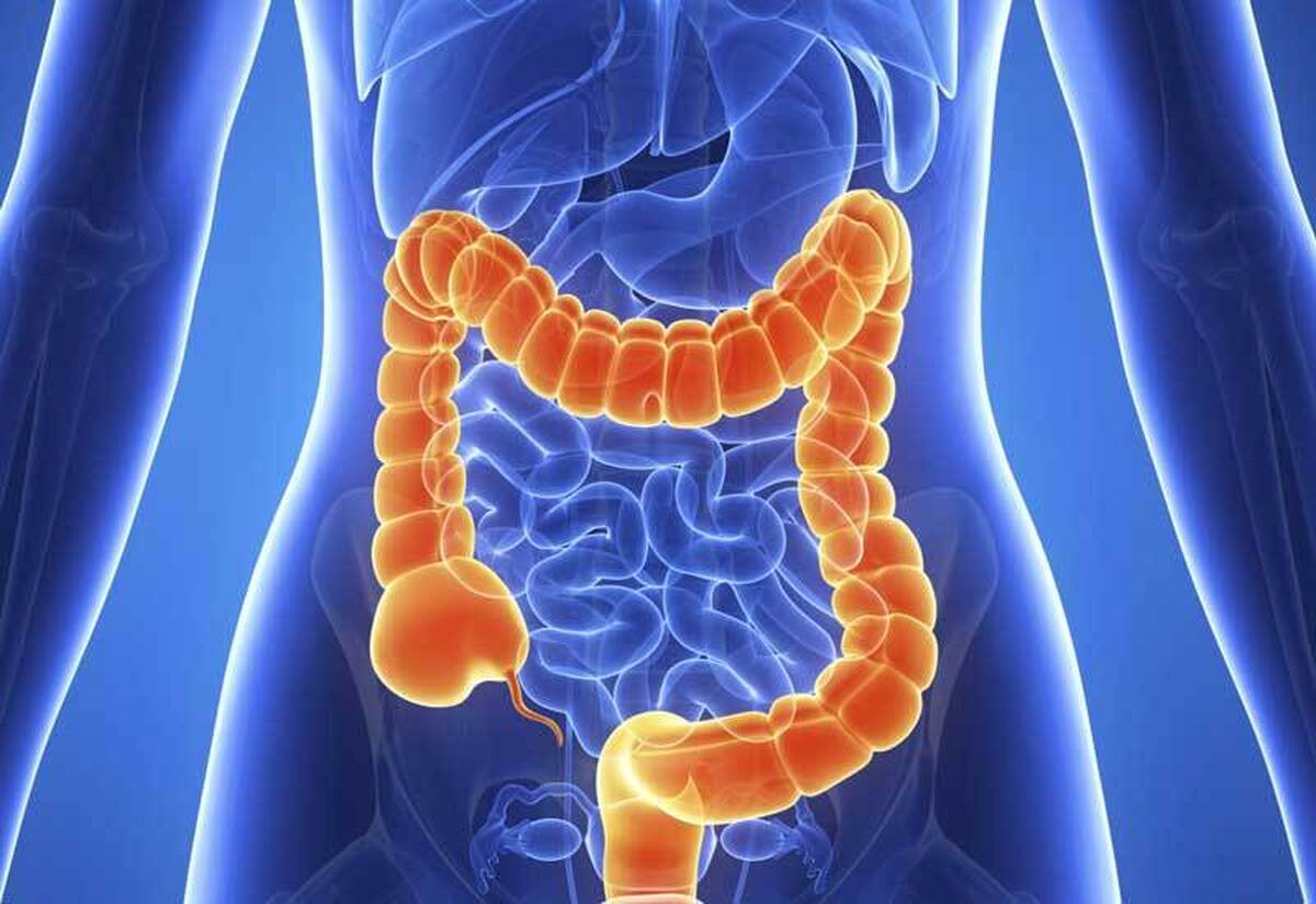 خوردن این غذا‌ها ریسک ابتلا به سرطان روده را بالا می‌برد