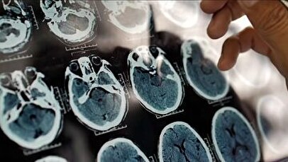 ۵ علامت هشدار دهنده پیری زودرس مغز