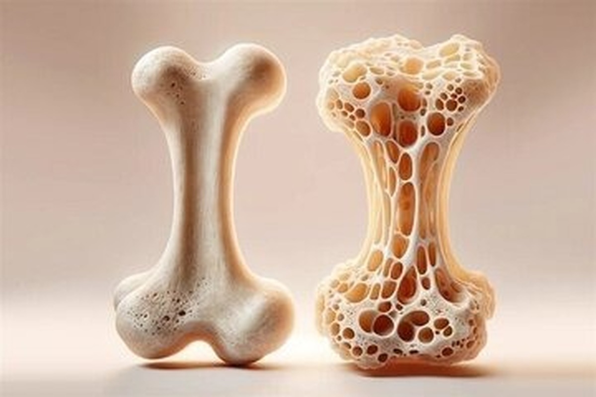 با این ویتامین‌ها استخوان‌های قوی بسازید!