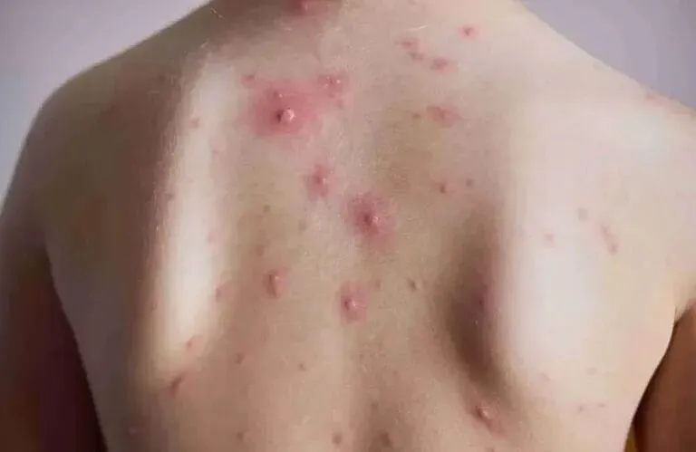 فصل آبله مرغان رسید، چه بخوریم تا زودتر خوب شویم