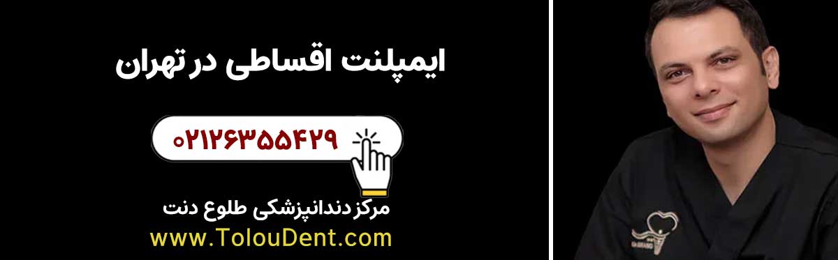 ایمپلنت اقساطی در تهران