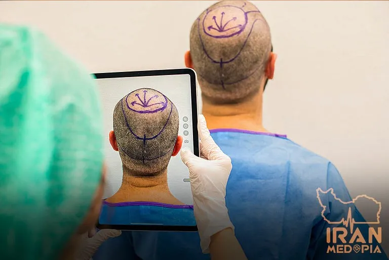 What are the 3 successful methods of hair transplantation in Iran?