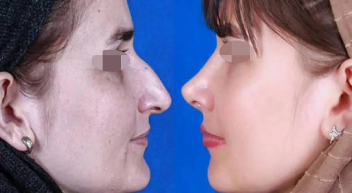 هزینه عمل بینی در سال ۱۴۰۴ / با چند میلیون می‌توانیم عمل بینی انجام دهیم؟